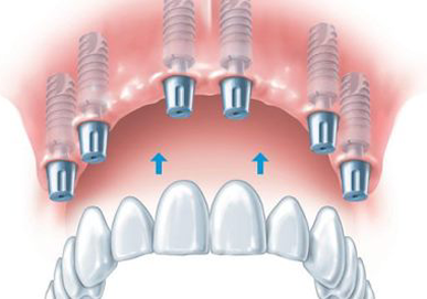 зубной протез с креплением на имплантах