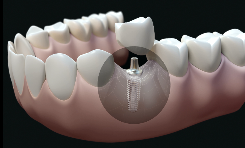 zobu implanti