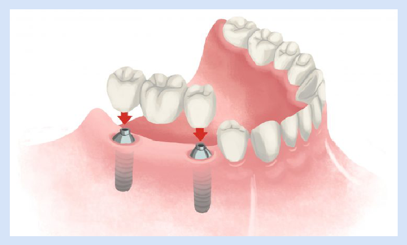 zobu protēzes